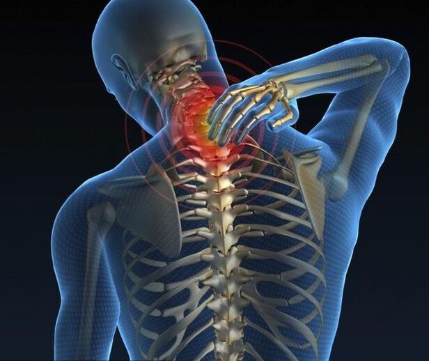 Osteocondrosi cervicale