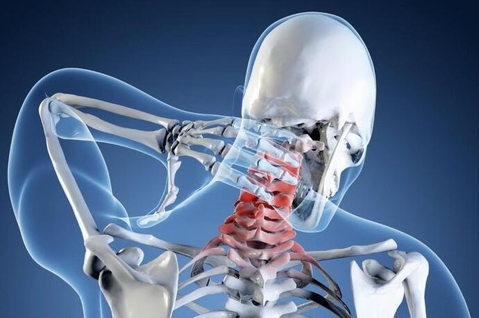 Osteocondrosi del 1 ° grado