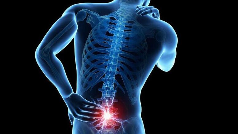 Sintomi di osteocondosi lombare